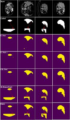 Rethinking Pooling Operation for Liver and Liver-Tumor Segmentations